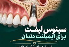 تصویر سینوس لیفت برای ایمپلنت دندان در کلینیک دندانپزشکی ایرانادنت