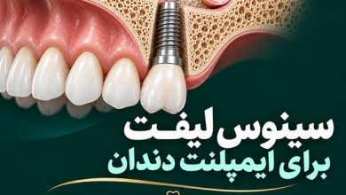 تصویر سینوس لیفت برای ایمپلنت دندان در کلینیک دندانپزشکی ایرانادنت