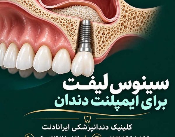 تصویر سینوس لیفت برای ایمپلنت دندان در کلینیک دندانپزشکی ایرانادنت